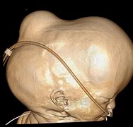 Image result for Hydranencephaly
