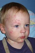 Image result for Chicken Pox