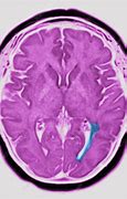 Image result for OCD MRI Scan