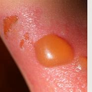 Image result for 3rd Degree Sun Burn Pictures