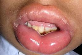 Image result for Food Allergy Lips