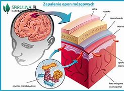 Image result for co_to_za_zapalenie_opon_mózgowych_i_mózgu