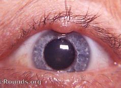 Image result for Lesion On Eyelid