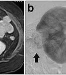Image result for Exophytic Cyst Kidney
