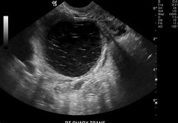 Image result for Ovarian Cyst While Pregnant