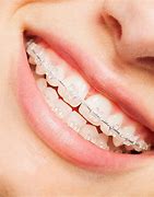 Image result for Clear Teeth Braces