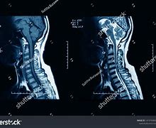 Image result for MRI of Cervical Spine without Contrast