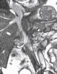 Image result for Renal Cell Carcinoma Metastasis