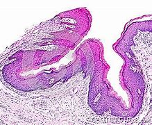 Image result for Cutaneous Papilloma