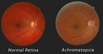 Image result for acr9matopsia
