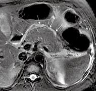 Image result for Pancreatitis MRI
