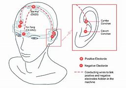 Image result for Transcutaneous Electrical Acupoint Stimulation