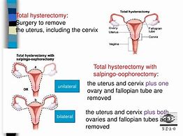 Image result for carcinoma_endometrium