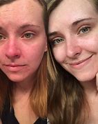 Image result for Bright Red Face