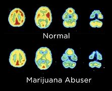 Image result for Positive Effects of Marijuana