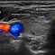 Image result for Thyroid Ultrasound Anatomy
