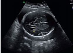 Image result for Lissencephaly Prenatal Ultrasound