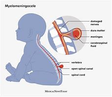 Image result for Myelomeningocele Baby