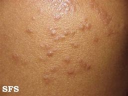 Image result for Scabies Fingers