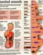 Image result for 5.56 Wound Cavity