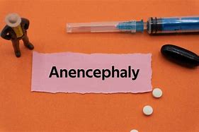 Image result for What Is Anencephaly Baby