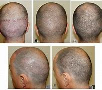 Image result for How Long Do Hair Transplants Last