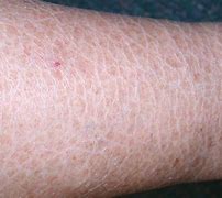 Image result for Dry Scaly Skin Cancer