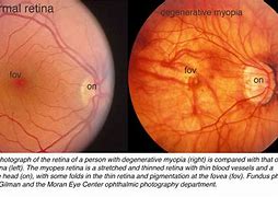 Myopia 的图像结果