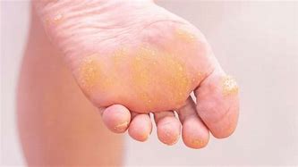 Image result for Calluses Warts Corns