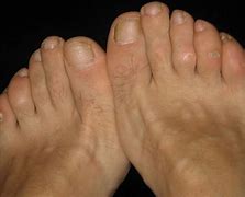 Image result for Black Seed Foot Wart