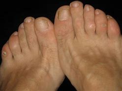 Image result for Corn On Foot After Treatment
