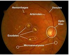 Image result for Retina Monitor