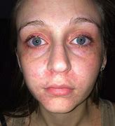 Image result for Fish Allergy Face