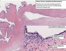 Image result for Serous Cystadenoma of Ovary