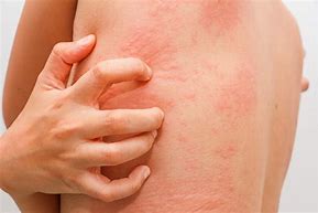 Image result for Allergic Reaction Skin Rash