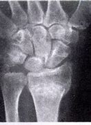Image result for Dorsiflexion Wrist Long Arm Cast