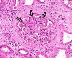Image result for IgA Nephropathy Histology