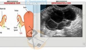 Image result for Right Adnexal Ovarian Cyst
