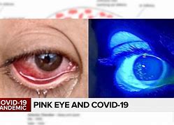 Image result for Covid Eyes Symptom