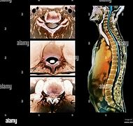 Image result for Vertebral Body MRI