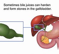 Image result for Biliary Drain Catheter