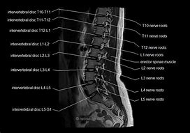 Image result for Lumbar MRI Anatomy