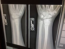 Image result for Broken Arm Cast