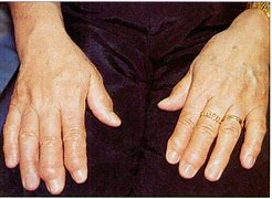 Image result for Polyarthritis