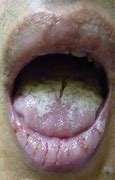 Image result for Genital Ulcers Male