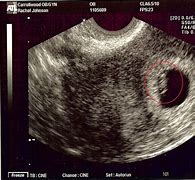 Image result for Pregnancy Ultrasound at 5 Weeks