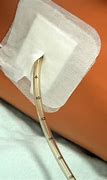 Image result for Patient with Chest Tube Drainage