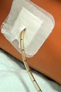 Image result for Thoracostomy Chest Tube Removal