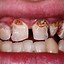 Image result for Decaying Teeth