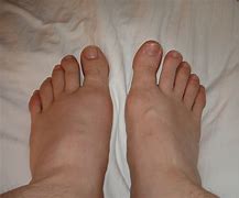 Image result for Extra Wide Shoes for Swollen Feet